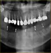 x-ray implant guide